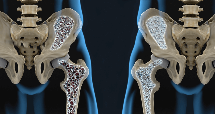Representação em 3D dos efeitos da osteoporose no osso